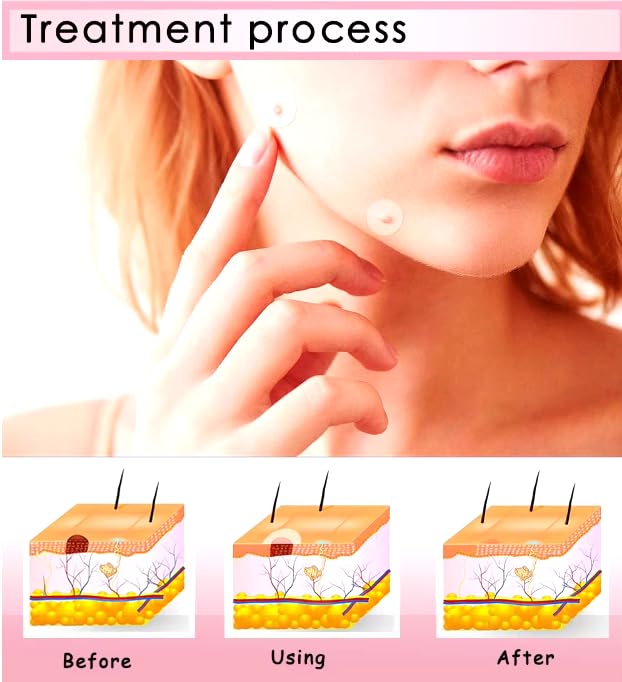 Acne Pimple Patches with Collagen & Vitamin C - Salicylic Acid Hydrocolloid Spot Treatment for Face (8mm & 12mm, 36 Count) | Organic, Sulfate-Free, Invisible | Perfect for Overnight Acne Care & Daily Blemish Cover