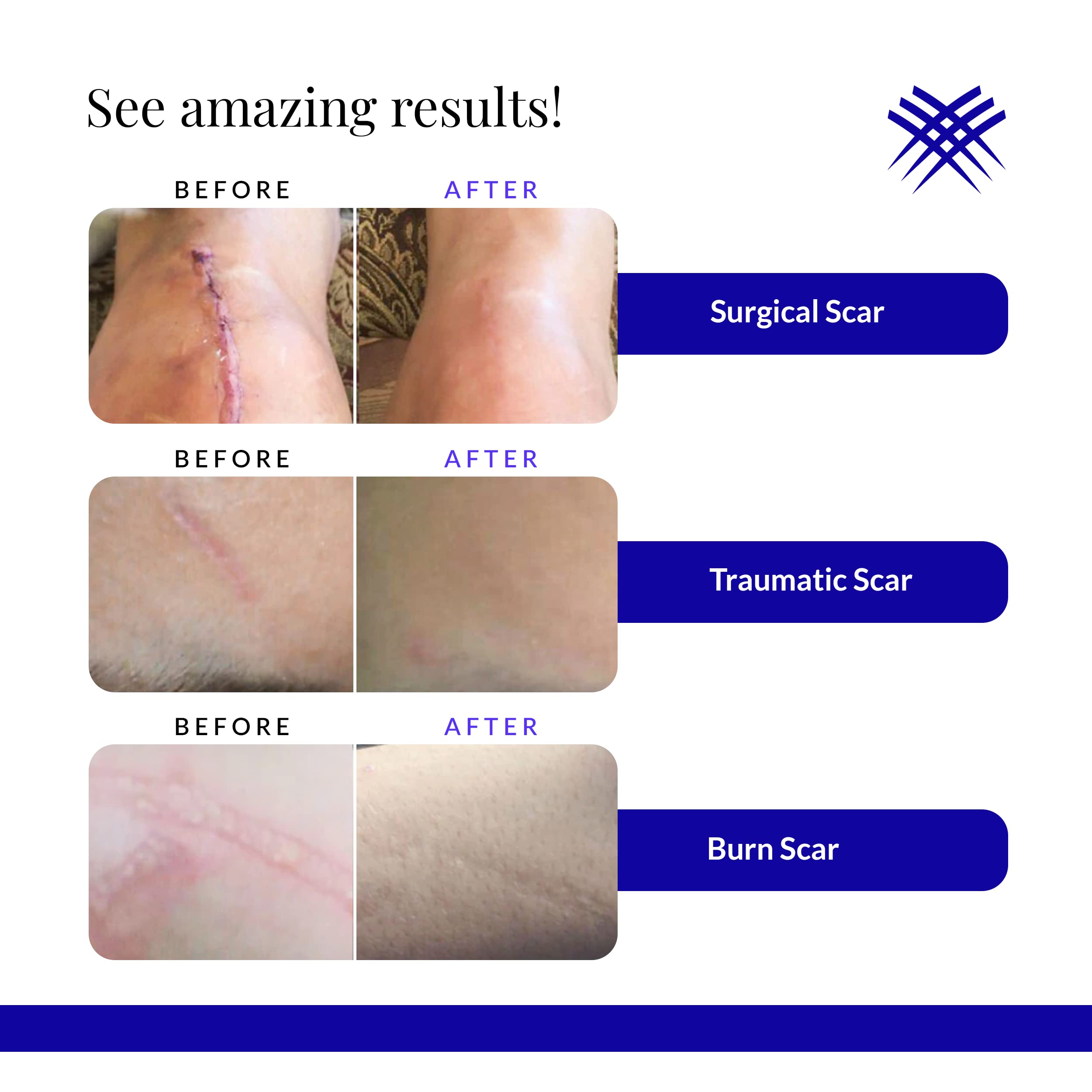 Rejuvaskin Scar Esthetique Scar Cream with Silicone - Reduces Surgical Scars, Burns, Stretch Marks, Keloids & Acne Scars - 30ml - Post-Surgery Recovery & Skin Care Treatment for Smooth & Healthy Skin