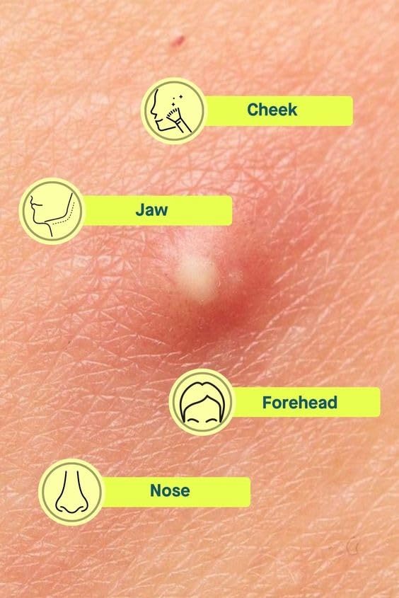 Hydrocolloid Acne Pimple Patch - 72 Dots | Fast Healing Spot Treatment for Zits, Blemishes & Breakouts | Vegan, Cruelty-Free Skincare | Face Care for Overnight Healing | Perfect for Teens & Adults with Acne-Prone Skin