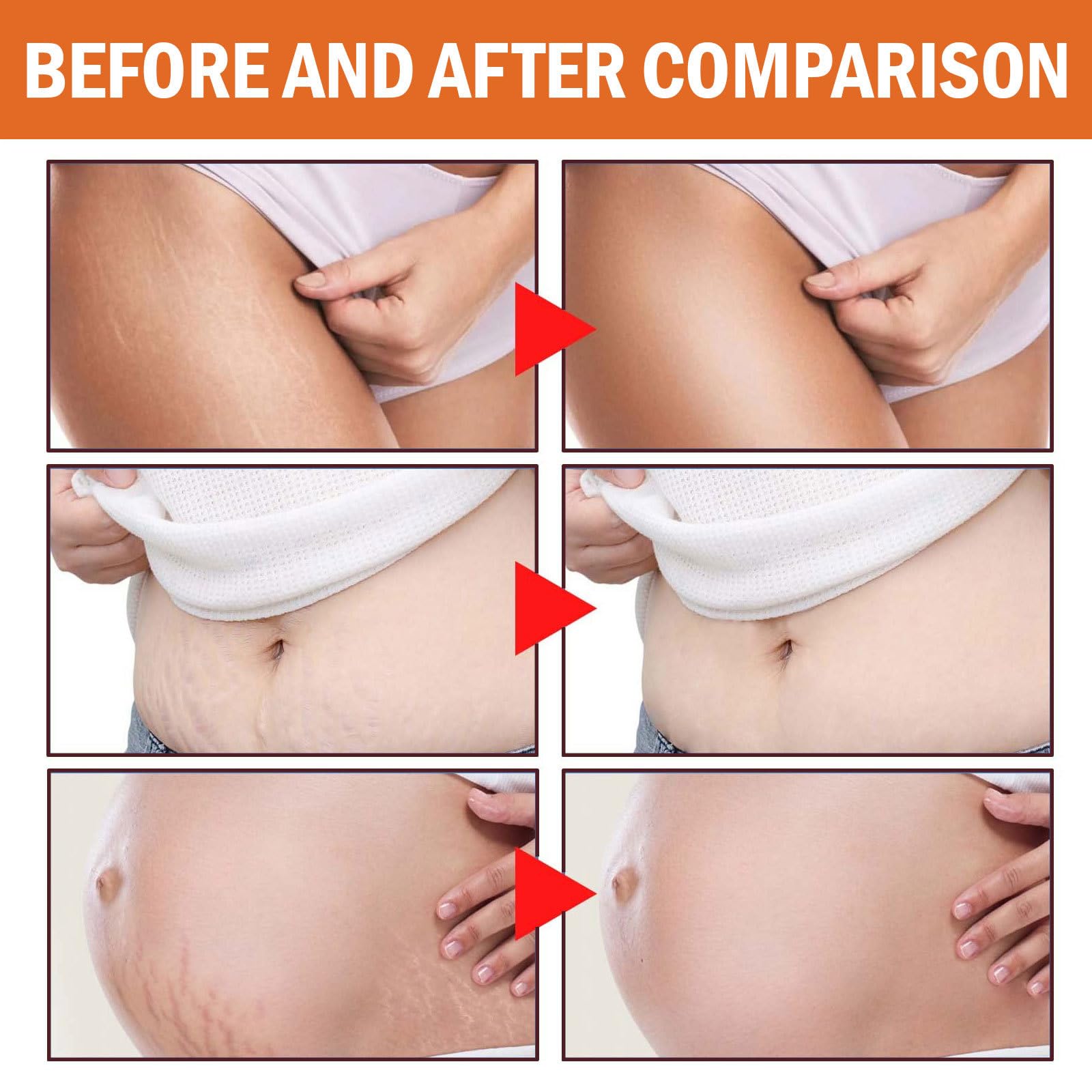 Grgowe Stretch Marks Removal Cream - Anti-Stretch Mark & Scar Repair Treatment for Pregnancy, Weight Loss & Body Care - Fast Absorbing Moisturizing Formula for Belly, Hips & Thighs