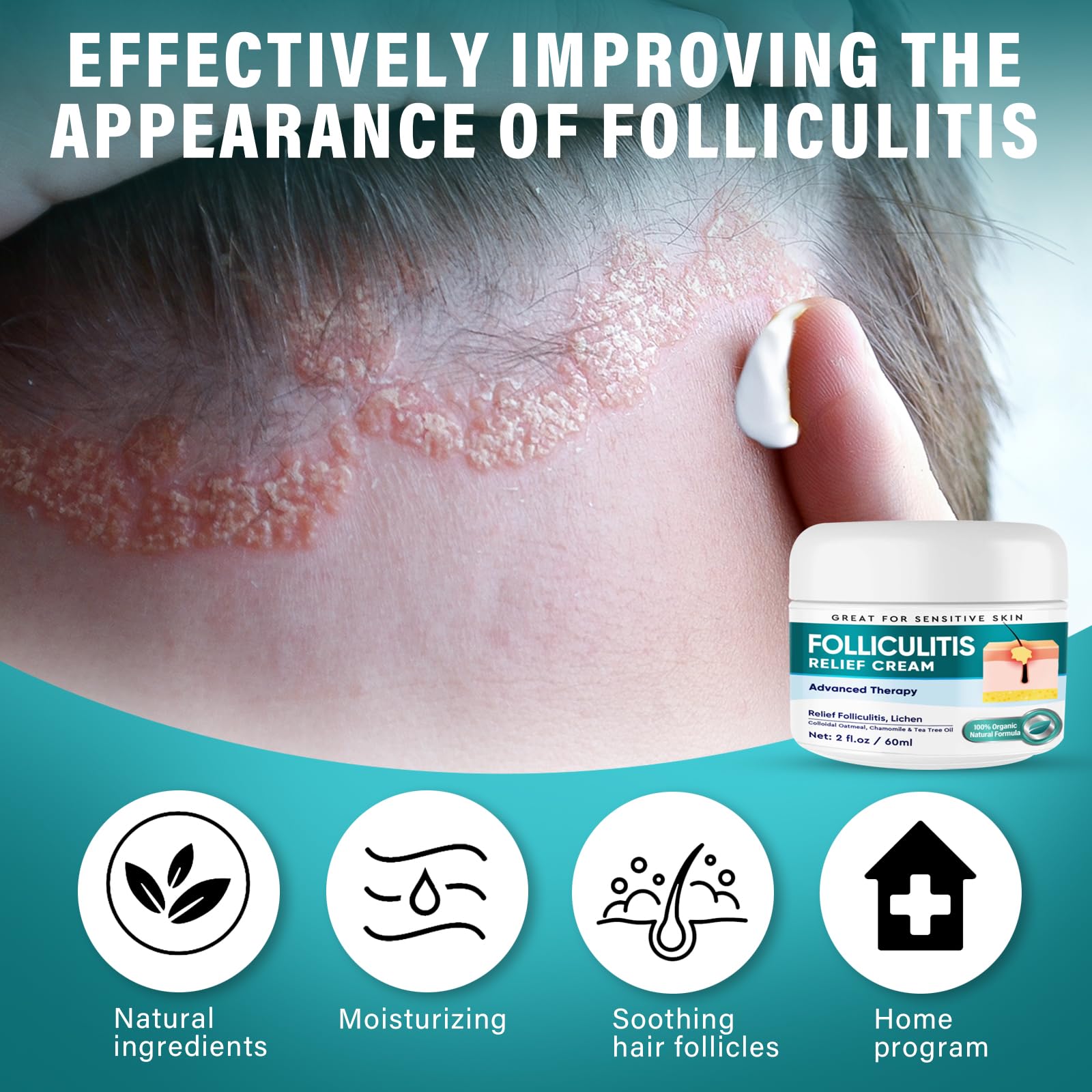 Dijkoo Folliculitis Treatment Cream for Face & Body - Severe Bumps & Irritation Relief for Men & Women - 60g - Soothes Razor Burns, Ingrown Hairs & Skin Inflammation | Perfect for Post-Shaving & Hair Removal Care
