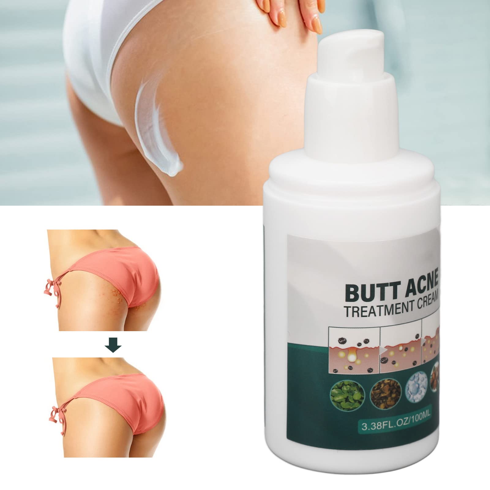 Best Buttock Pimple Treatment Cream - Acne Cleansing & Skin Moisturizing Repair for Thigh & Butt Area | Prevent & Soothe Breakouts for Smooth Skin | Perfect for Post-Workout, Travel & Daily Care