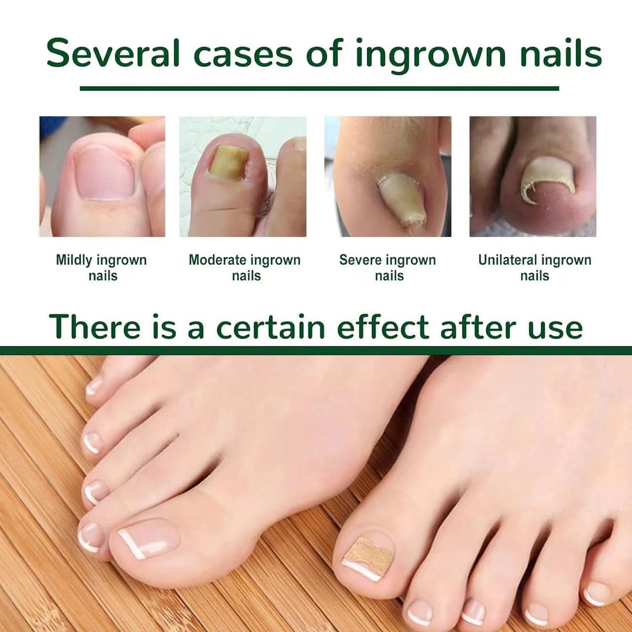 50 Pcs Ingrown Toenail Corrector Patches - Breathable, Painless & No Glue Nail Correction Treatment - Stays Secure, Fast Relief for Ingrown Nails - Perfect for Athletes, Runners & Daily Comfort