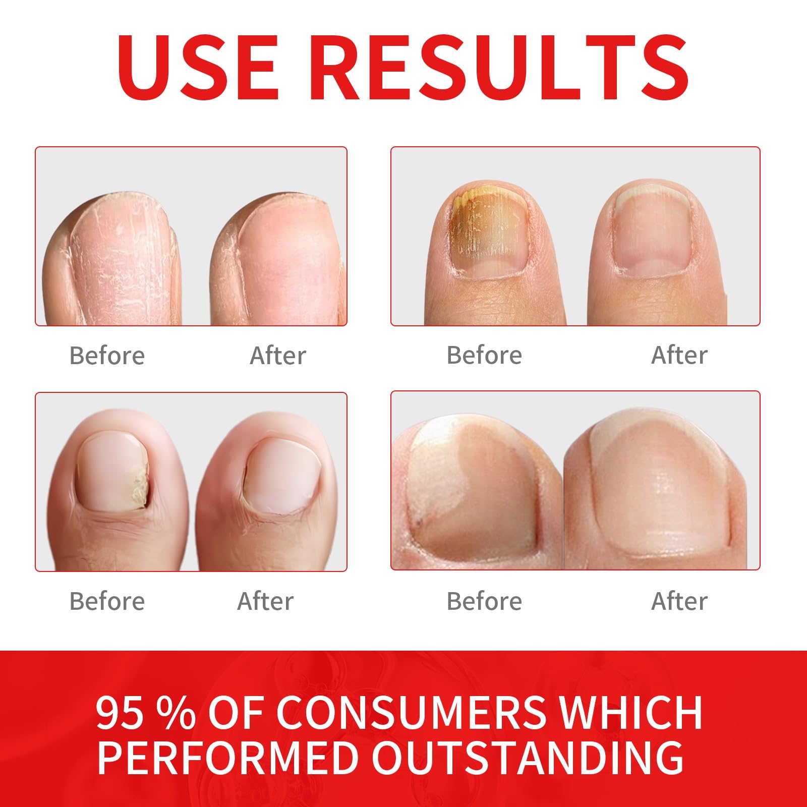Extra Strength Toenail Fungus Treatment Liquid with Soft Brush Head - Fast & Effective Fungal Nail Solution (30ml) for Healthy Toenails - Perfect for Athletes, Swimmers & Daily Foot Care