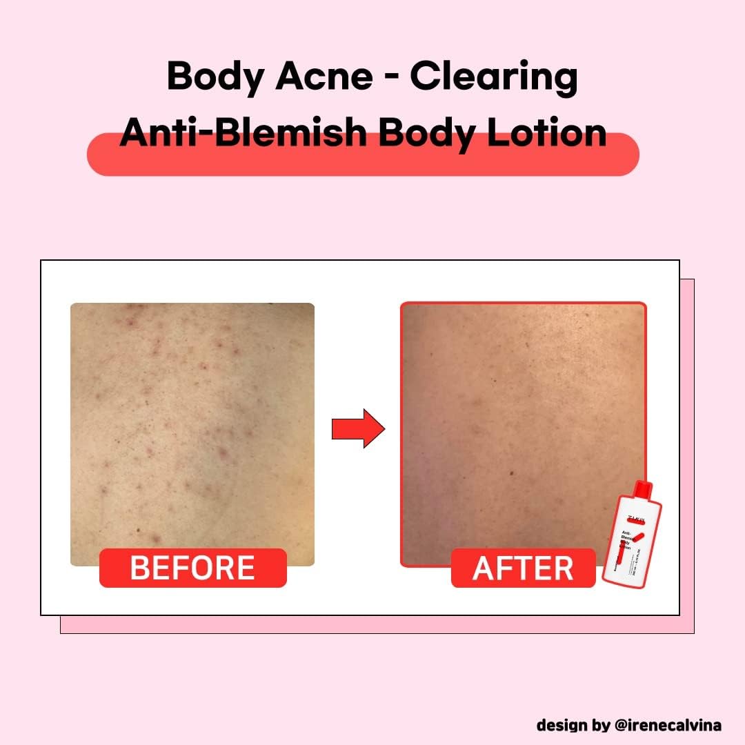 TIA'M Anti-Blemish Body Lotion for Acne Treatment - 6.76 Fl Oz Body Acne Cream for Bacne & Breakouts - Clear Skin Care for Back, Chest & Shoulders - Perfect for Gym, Sports & Active Lifestyles