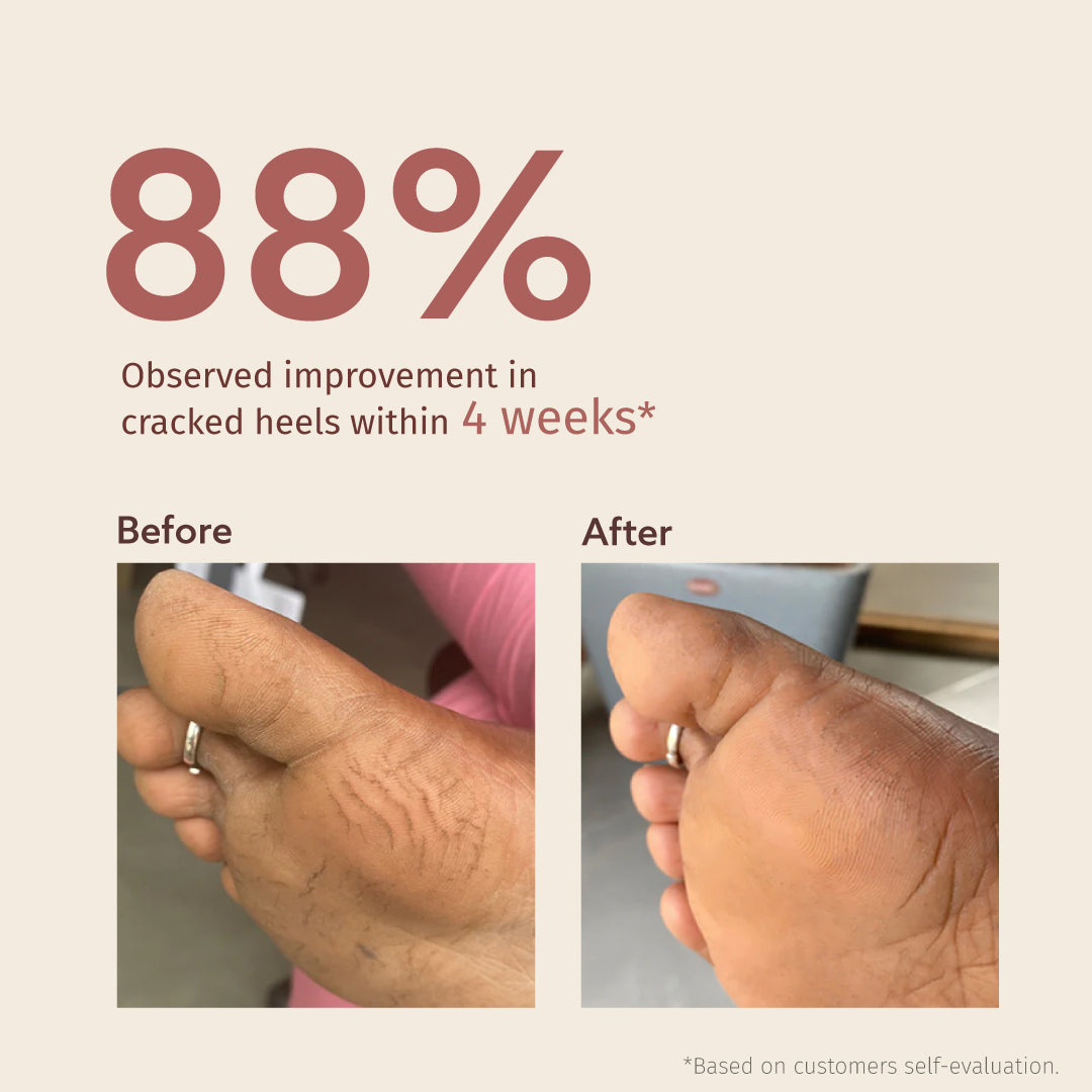 Best Foot Cream for Cracked Heels - Intensive Moisturizing Treatment for Dry, Rough Feet - Perfect for Daily Use at Home, Spa & Travel