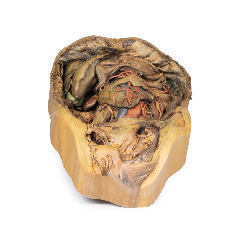 3D Printed Abdomen Model with Inguinal Hernia - Medical Training & Anatomy Study Tool for Students, Doctors & Surgeons