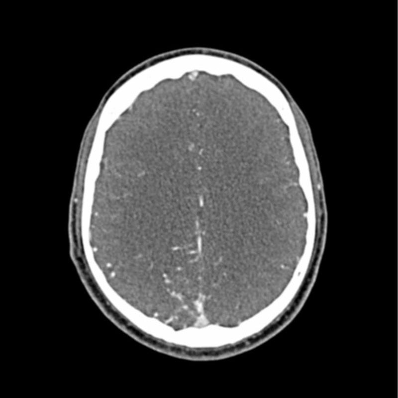 Head and Neck CTA Phantom AVM for CT Scan & X-Ray Training - Medical Imaging Practice, Radiology Education, and Diagnostic Testing