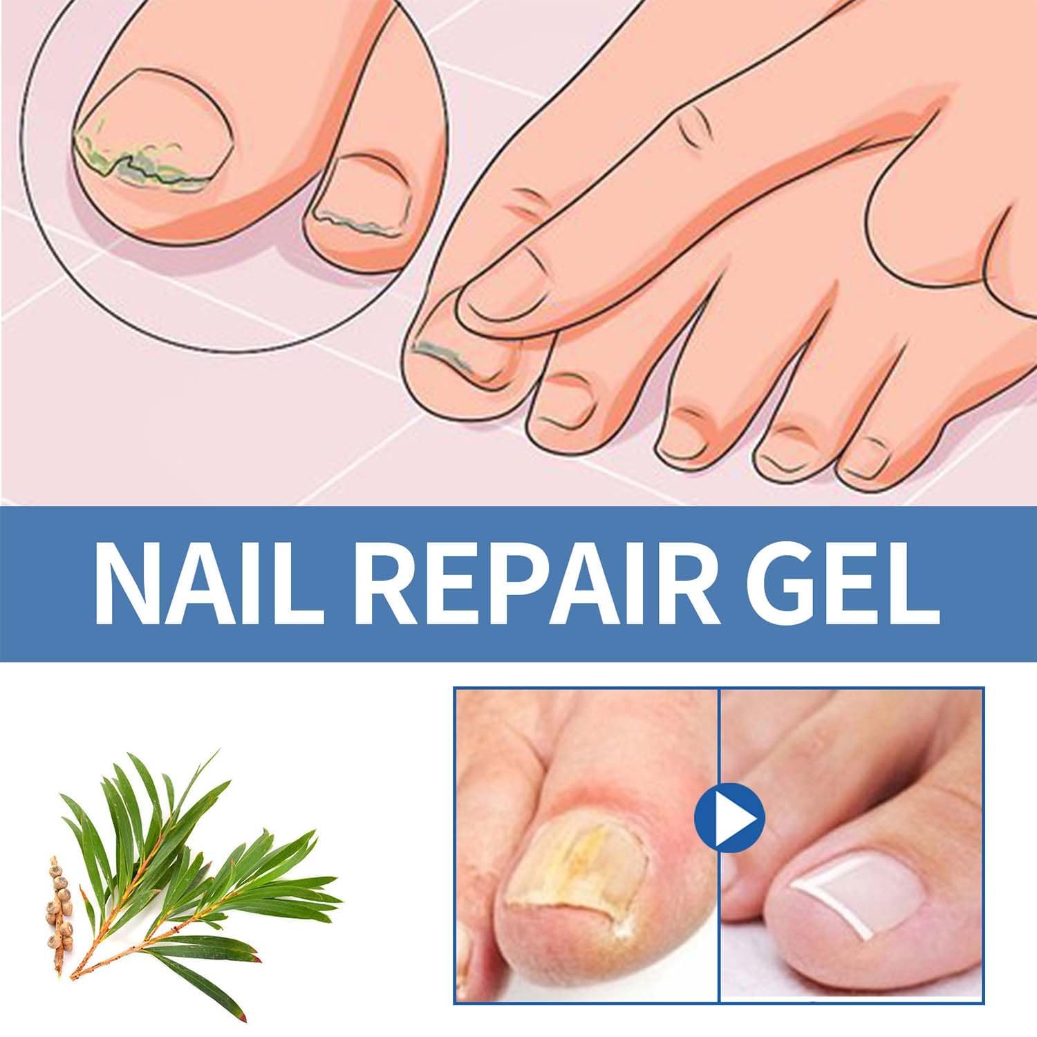 Postur Nail Gel - Fungus Treatment & Nail Care for Damaged & Discolored Nails - Strengthens & Restores Healthy Nails - Perfect for Toenail & Fingernail Fungus Treatment at Home (1pc)