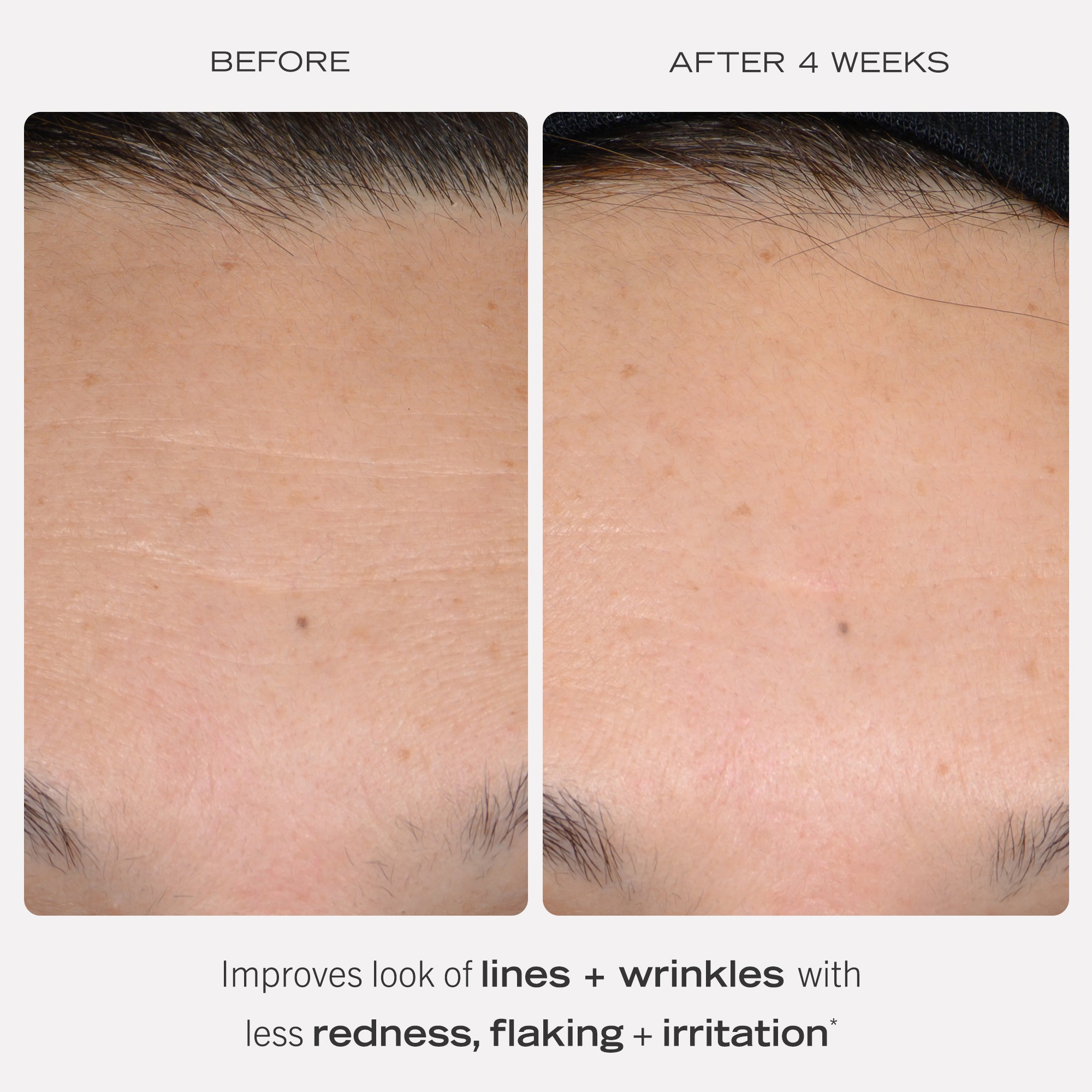 0.3% Retinol Complex Serum with Peptides - Anti-Aging Face Treatment for Wrinkles & Fine Lines - Perfect for Night Skincare Routine