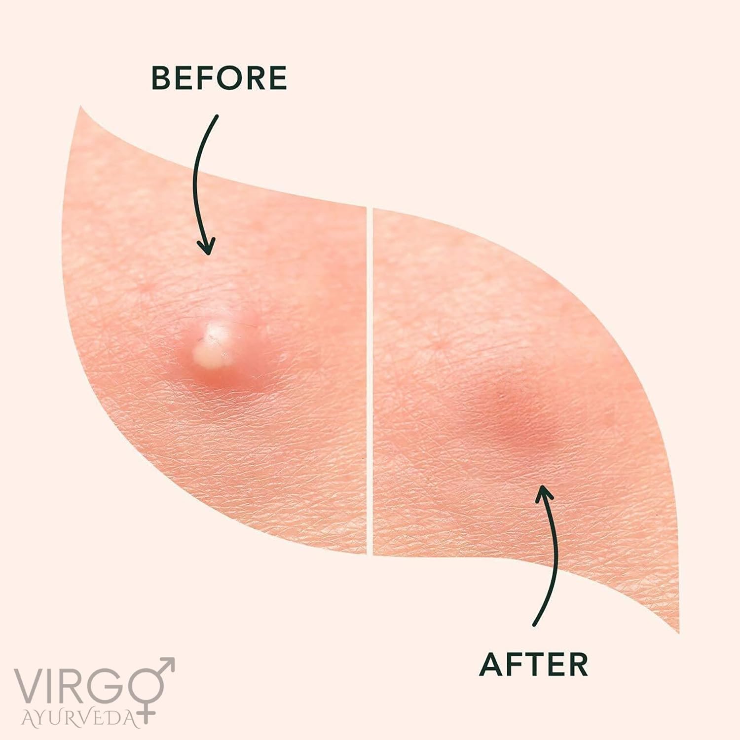 Virgo Ayurveda Hydrocolloid Acne Pimple Patches with Tea Tree & Neem - 72 Count Spot Treatment Stickers for Face & Skin | Fast Healing for Zits, Blemishes & Breakouts | Perfect for Overnight Use & Travel