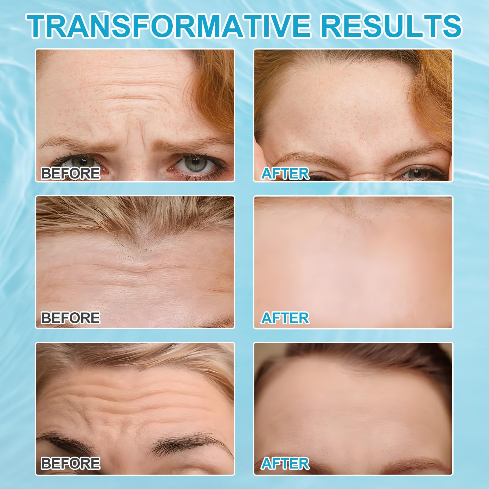 Frovetani Forehead Wrinkle Patches 12PCS - Natural Anti-Aging with Aloe, Collagen & Vitamin E - Reduce Fine Lines & Wrinkles - Forehead Wrinkle Treatment for Smooth Skin - Perfect for Night Care & Daily Use