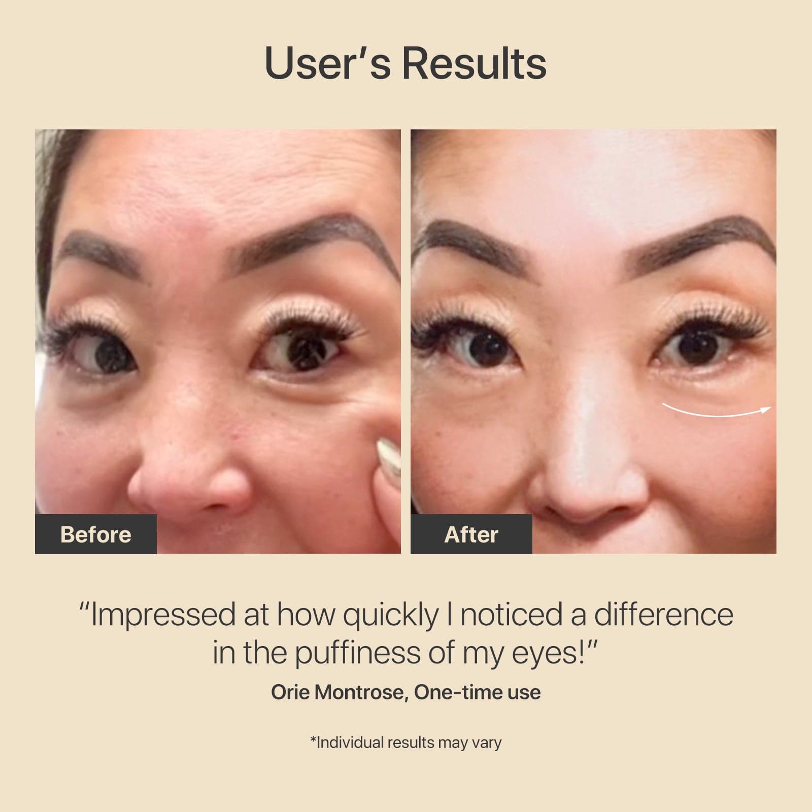 AMIRO R3 Turbo Facial RF Skin Tightening Device - Anti-Aging & Wrinkle Reduction for Face & Neck - At-Home Skincare Treatment for Lifting & Firming - Perfect for Daily Beauty Routine & Spa-Like Experience
