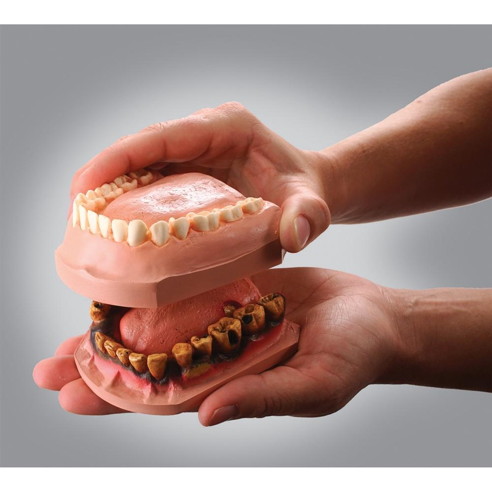 Dip n Decay™ Dental Caries Model Set - Professional Teeth Decay Demonstration Kit for Dental Students & Educators - Perfect for Classroom Teaching & Clinical Training