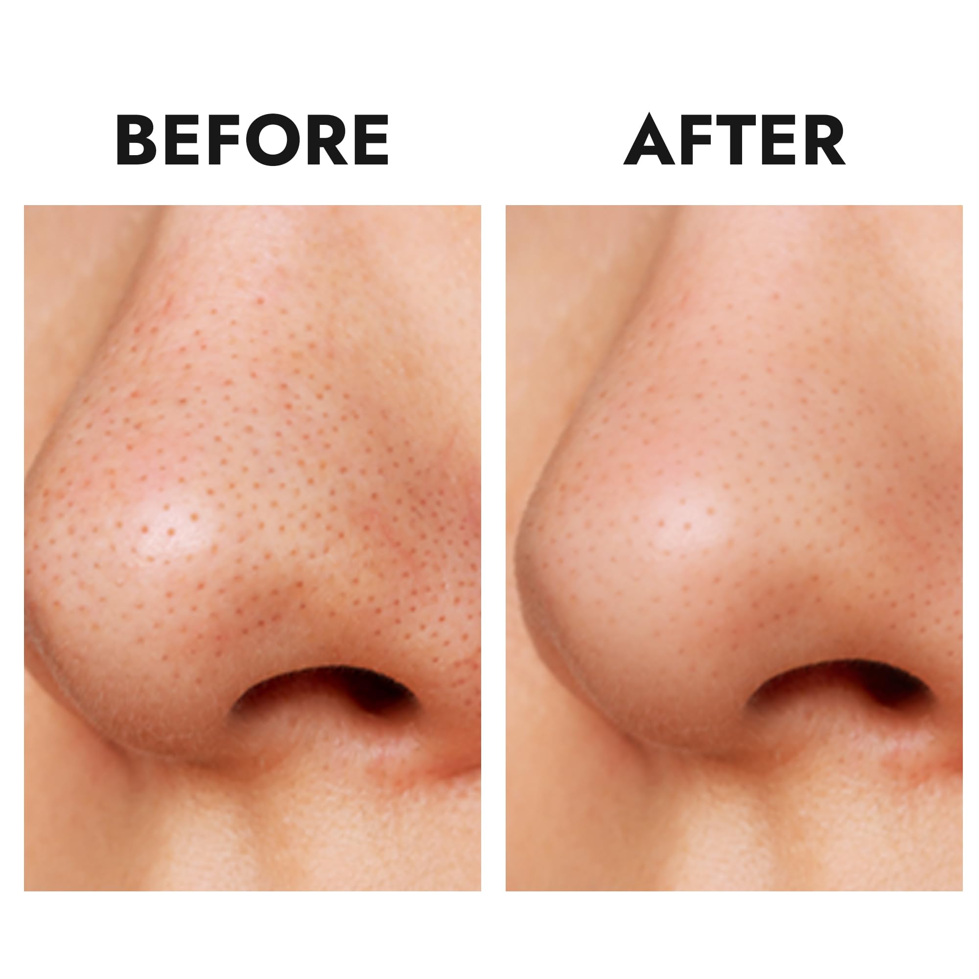Epielle Over-Zit Nose Patches - Hydrocolloid Acne Treatment for Clear Skin | 10 Count Pimple and Blemish Patches for Nose | Perfect for Overnight Spot Treatment and Easter Gifts