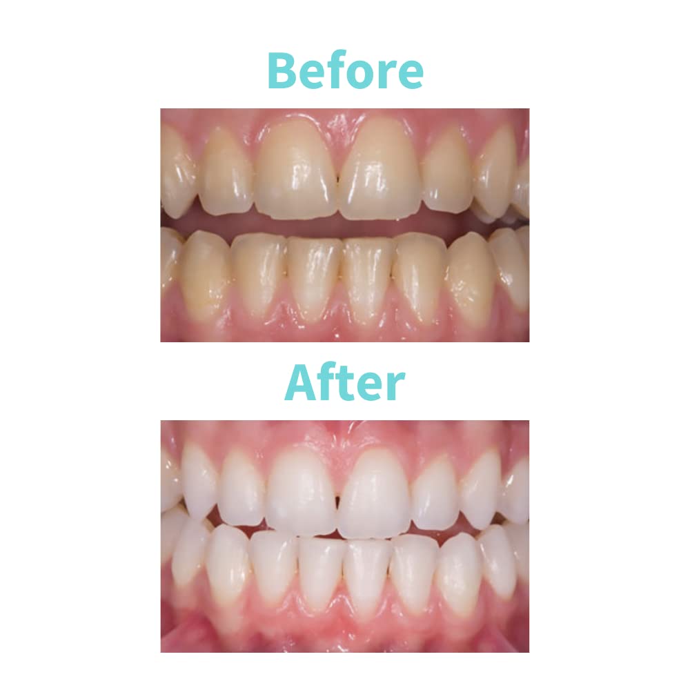 Professional Teeth Whitening Gel Syringe Refill - 2 Syringes of 3ml Gel with 10% Carbamide Peroxide | Powered by Novon Technology | Brighten Smile at Home for Weddings, Dates & Job Interviews