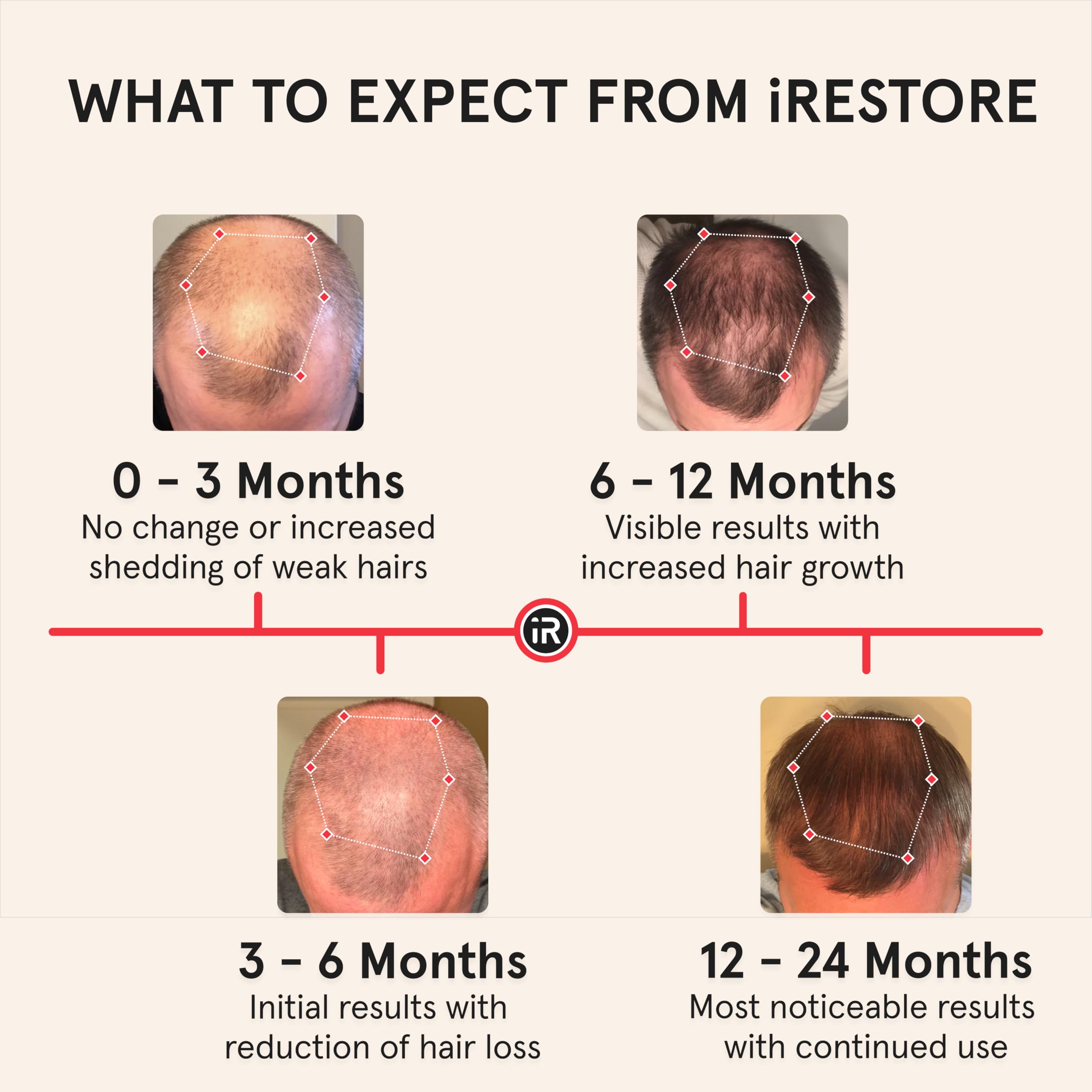 iRestore Professional Laser Red Light Therapy Hair Growth System - FDA Cleared Hair Loss Treatment for Men & Women - 282 Lasers & LEDs Laser Cap for Hair Regrowth - Effective for Alopecia & Thinning Hair - Perfect for Home Use & Salon Treatments