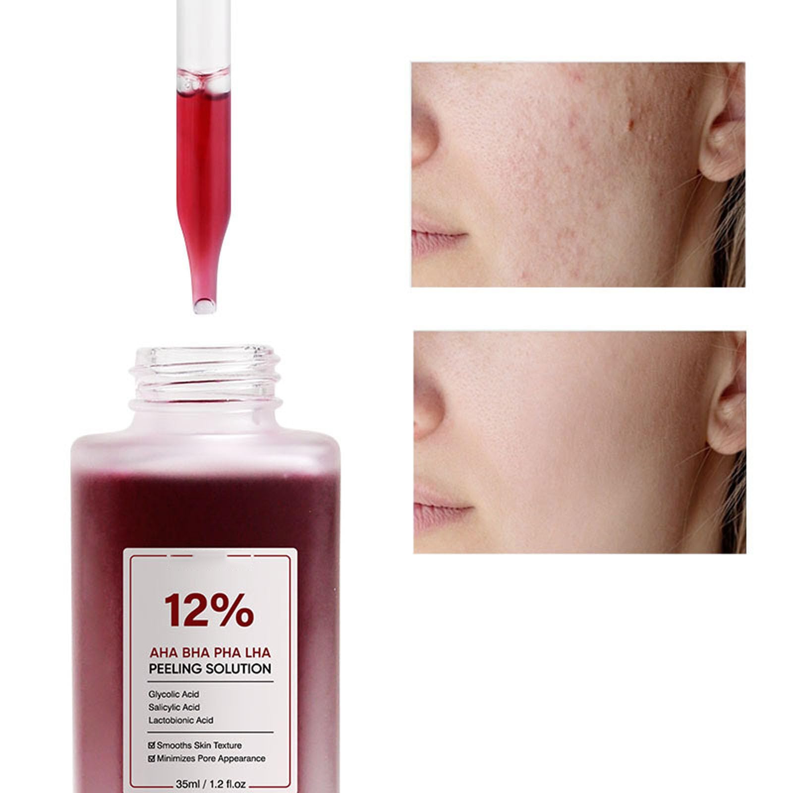 12% AHA BHA PHA LHA Peeling Solution Serum 30ml - Skin Brightening, Exfoliating, Pore Minimizing Treatment for Dark Spots & Blackheads (3 Pack) | Perfect for Nighttime Skincare Routine & Acne-Prone Skin