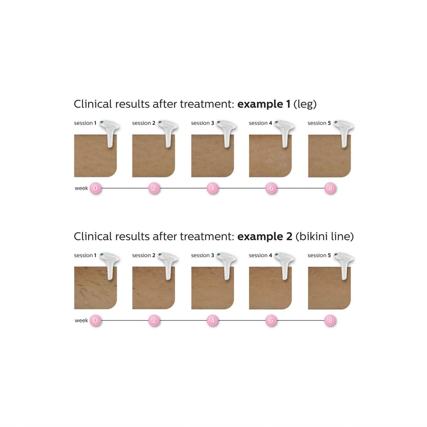 Philips Lumea Advanced IPL Hair Removal Device for Women & Men - Permanent Hair Removal for Face, Body & Bikini Line - SC1999/00 - At-Home Laser Hair Removal for Smooth Skin