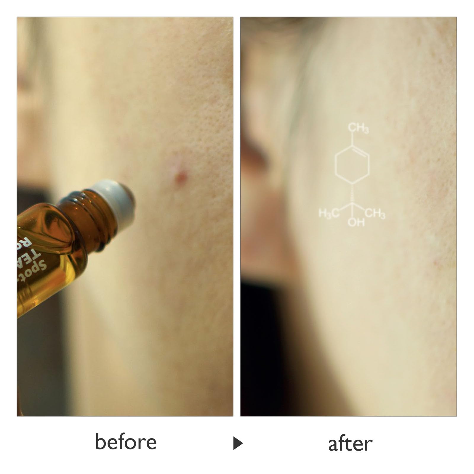 Tea Tree Acne Roll-On Treatment for Sensitive Skin - Spot Care for Pimples & Blemishes - Perfect for Travel & Daily Use