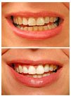 Professional Teeth Whitening Gel Syringe - 36% Carbamide Peroxide, 10ml for Instant White Smiles - Includes Whitening Trays - Perfect for At-Home Teeth Whitening & Brightening Your Smile for Special Occasions
