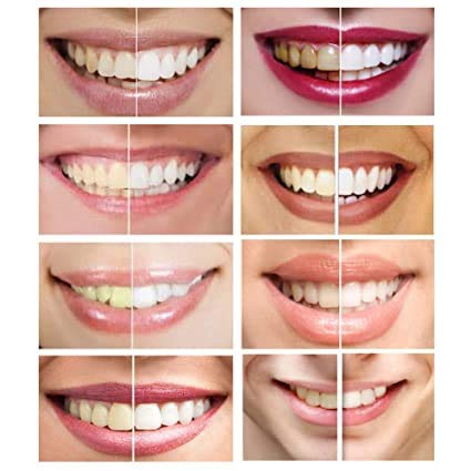 Professional Teeth Whitening Gel Syringe with 44% Carbamide Peroxide - Dental Bleaching Gel for Brighter Smile (3ml, 1-Pack) - Perfect for Home Use, Travel & Professional Dental Care