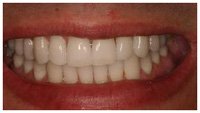 INSTANT WHITE SMILES 36% Teeth Whitening Gel - Professional Deep Stain Removal with 2x10ml Syringes & 2 Remineralizing Trays | At-Home Whitening Kit for Coffee, Wine & Smoking Stains