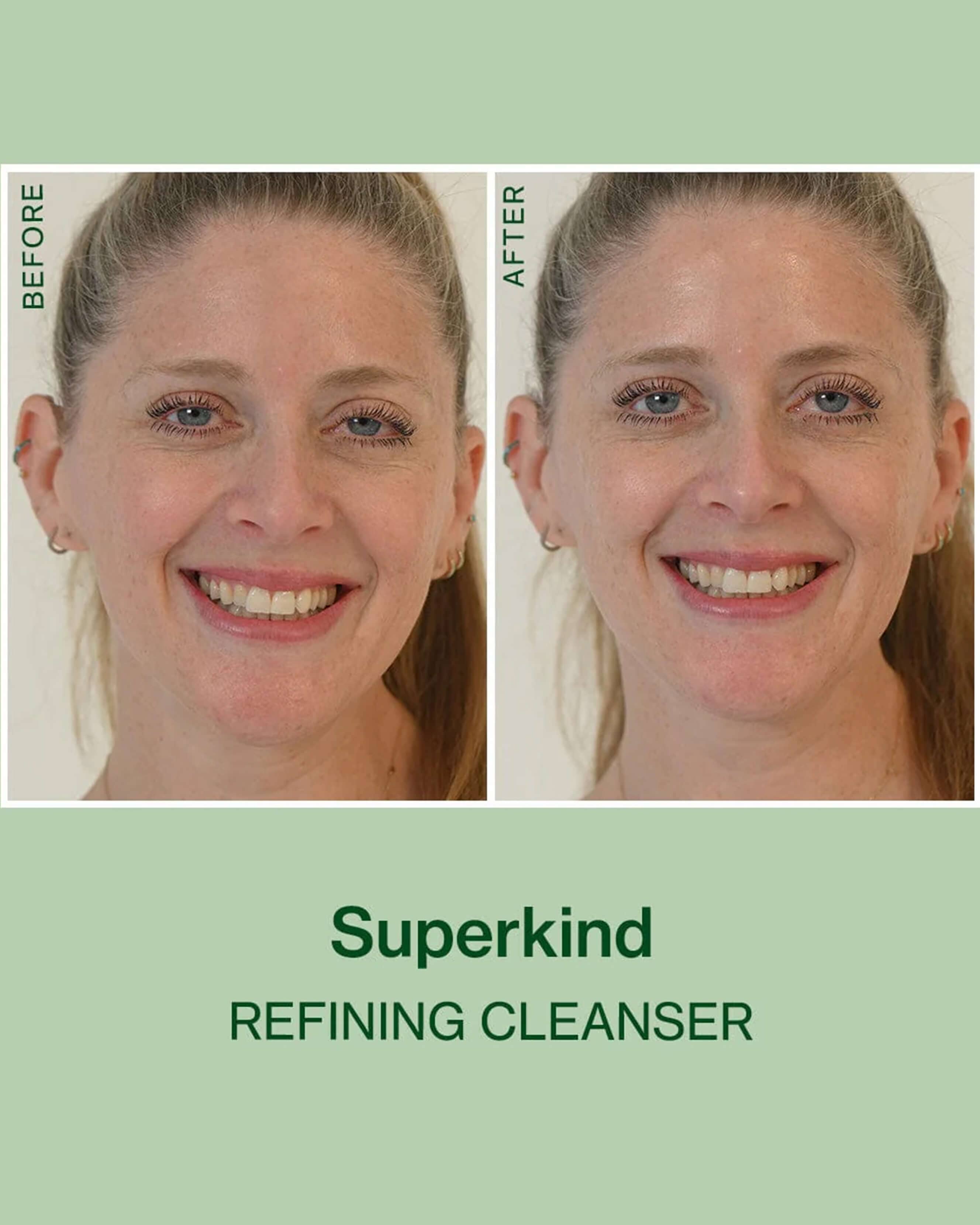 SUPERKIND Refining Cleanser - Gentle Exfoliating Face Wash for Sensitive Skin | Daily Skincare Routine, Acne Treatment & Pore Minimizing