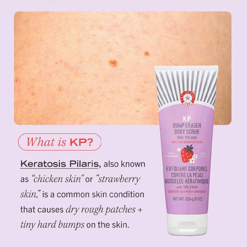 First Aid Beauty KP Bump Eraser Body Scrub with Fresh Strawberry - Exfoliating Treatment for Keratosis Pilaris & Smooth Skin - Perfect for Shower & Pre-Shave Routine