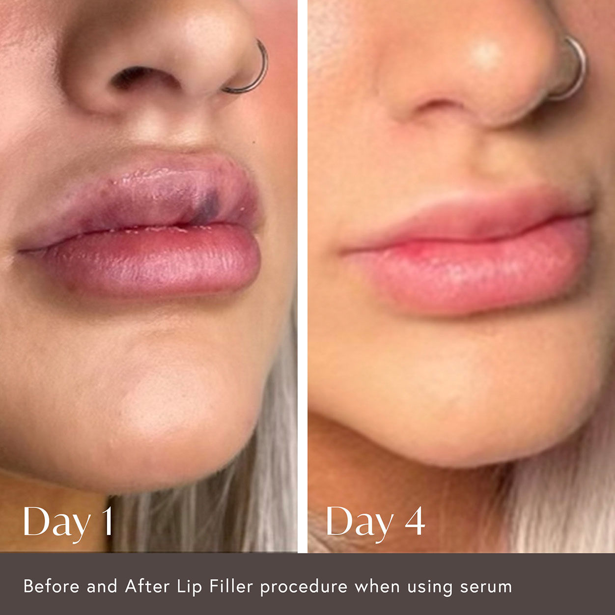 Hidden Agenda Pre and Post Injection Care Serum – Anti-Aging & Skin Recovery Treatment for Wrinkles & Fine Lines | Perfect for Botox, Fillers, and Cosmetic Procedures
