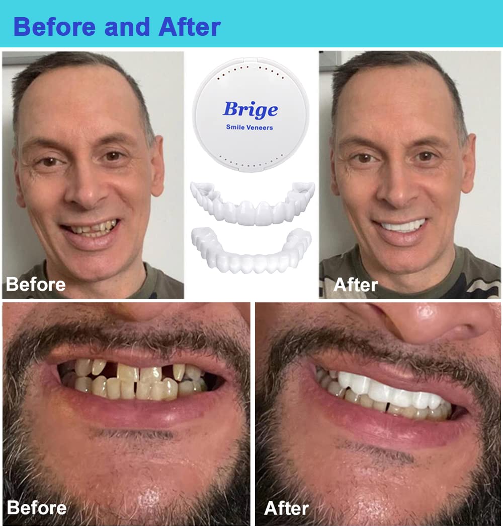 Temporary Denture Teeth - Snap-On Fake Teeth for Instant Smile & Confidence Boost - Perfect for Cosplay, Halloween, and Dental Emergencies