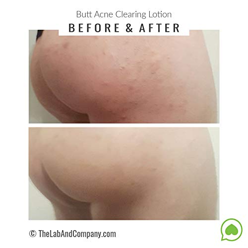 Best Clearing Lotion for Body Acne - Treat Back, Bum & Thigh Breakouts | Gentle Exfoliating Formula for Smooth Skin | Perfect for Post-Workout & Daily Skincare Routine