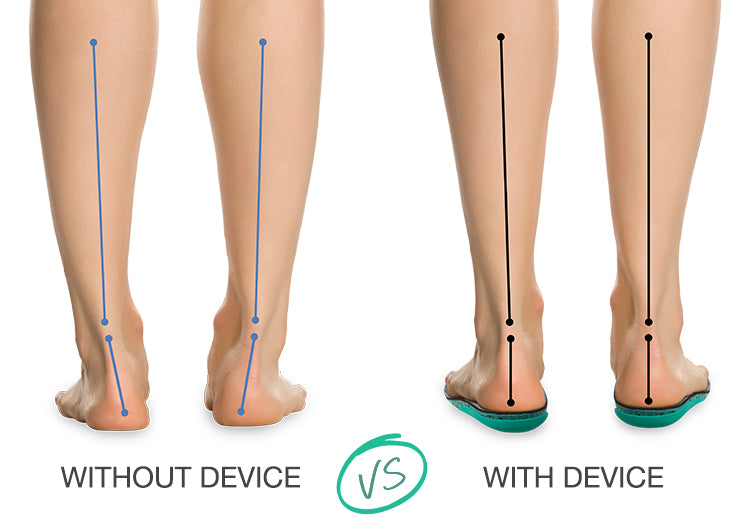 Best Anti Supination Device for Foot Support - Correct Overpronation & Improve Posture - Ideal for Running, Walking & Sports