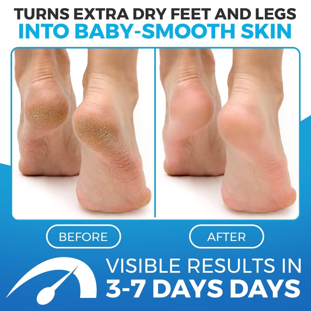Imperial Feet Foot Balm - 150ML Honey Moisturizing Cream for Dry, Cracked Heels & Athlete's Foot | Hard Skin Remover & Cracked Heel Repair | Softens, Smooths & Soothes Dry Skin - Ideal for Daily Foot Care, Pedicures & Post-Workout Recovery