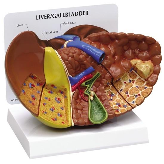Human Diseased Liver (Cancer) Anatomy Model - Detailed Medical Study Tool for Doctors, Students & Researchers | Perfect for Medical Education, Diagnosis Practice & Pathology Studies