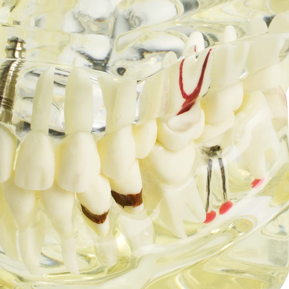 Dental Teeth Model - Transparent Implant Disease Removable Tooth Demonstration Kit for Dental Students & Professionals | Perfect for Classroom Teaching, Clinical Training & Patient Education