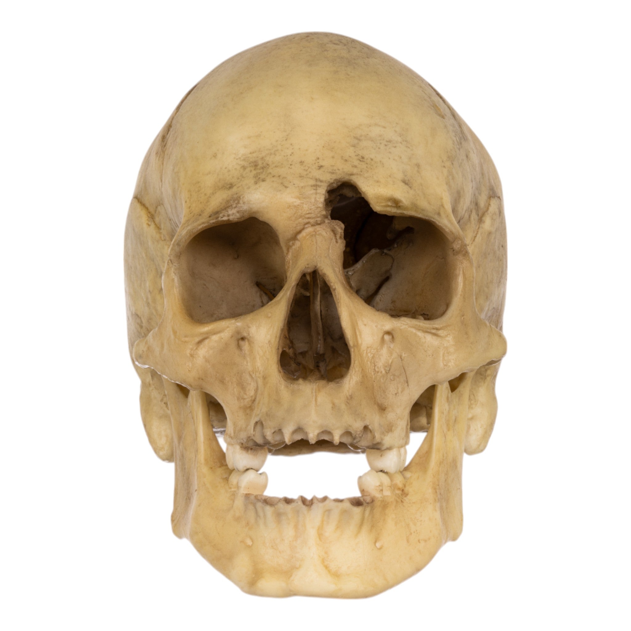 Realistic Replica Human Male Skull with 32 Caliber Gunshot Wound - Perfect for Medical Training, Forensic Studies, and Halloween Decorations