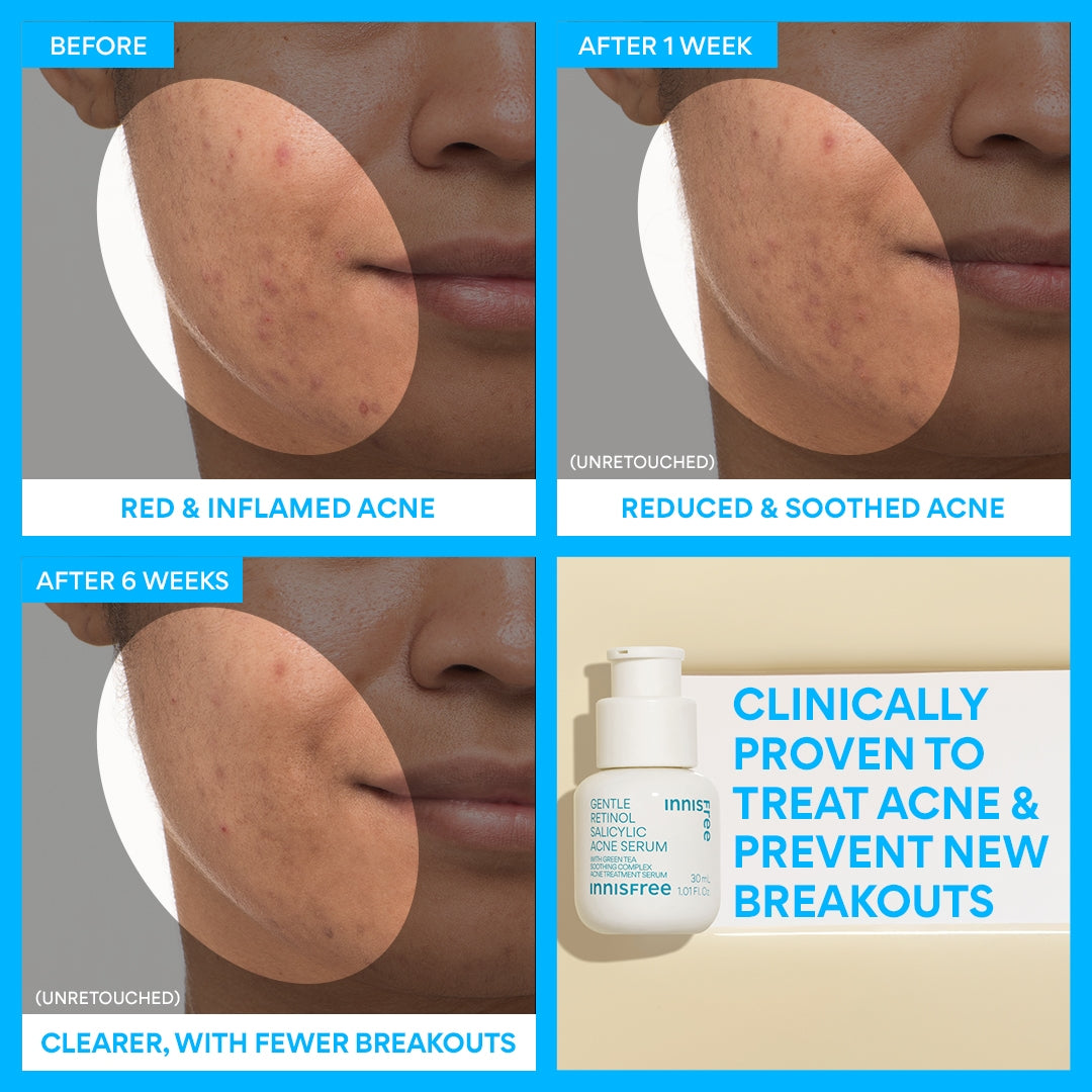 Gentle Retinol & Salicylic Acid Acne Serum for Clear Skin - Fights Breakouts & Reduces Blemishes - Perfect for Oily & Acne-Prone Skin