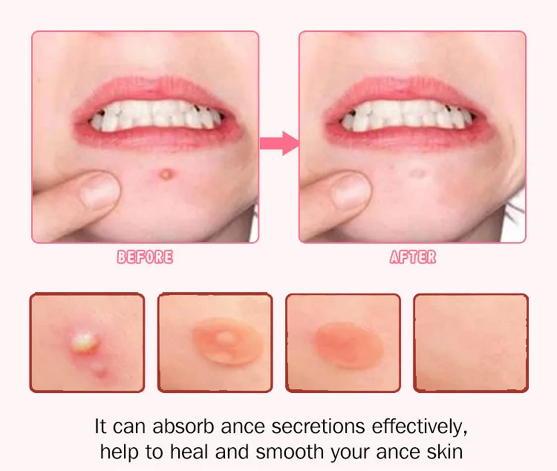 Original Hydrocolloid Acne Patches for Pimples & Blemishes - Vegan-Friendly, Cruelty-Free (36 Count) - Face & Skin Spot Treatment Stickers for Overnight Healing & Daily Use