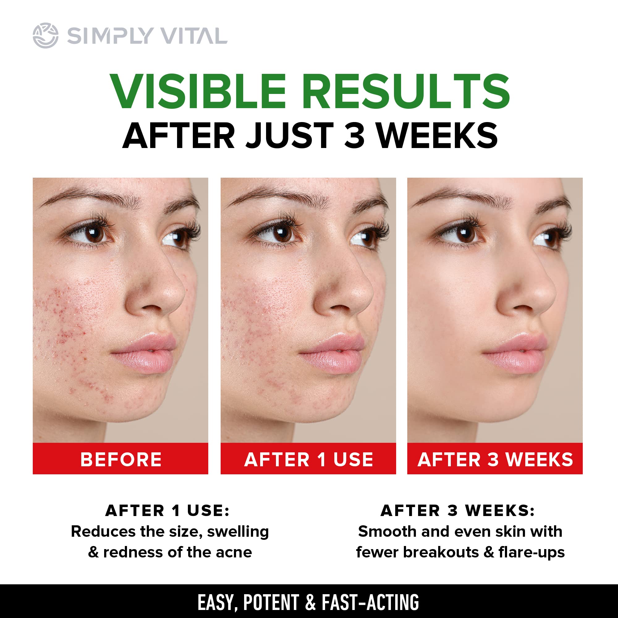 Fast-Acting Acne Treatment Cream for Stubborn Pimples, Blackheads & Whiteheads - Made in USA | Soothing Moisturizer for Inflammation Relief & Acne Scar Prevention (2oz) - Perfect for Daily Skincare Routine & Teen/Adult Acne Care