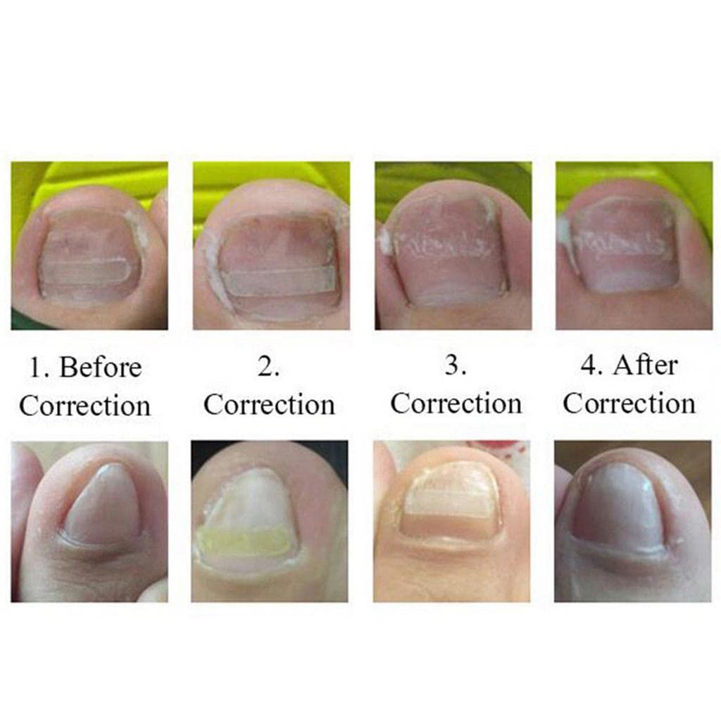MYADDICTION Ingrown Toenail Correction Patch Kit - Professional Toenail Care Tool for Pain Relief & Paronychia Treatment | Perfect for Pedicure, Manicure & At-Home Nail Care | Ideal for Daily Use, Post-Surgery Recovery & Nail Salon Professionals