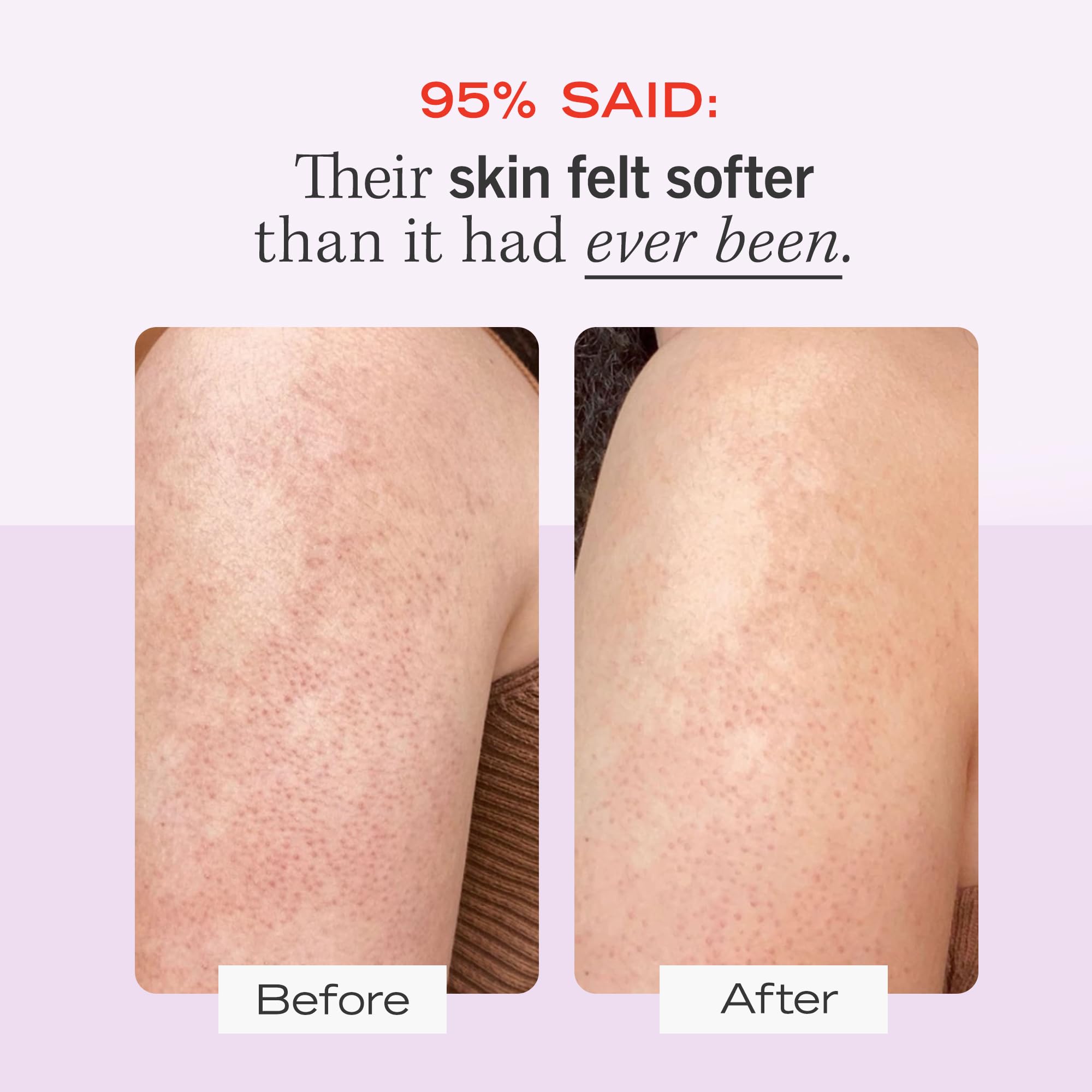First Aid Beauty KP Bump Eraser Body Scrub - 10% AHA Exfoliator for Keratosis Pilaris with Glycolic & Lactic Acids - Reduces Chicken Skin Bumps - Gentle for Sensitive Skin - 10 oz - Perfect for Dry, Rough Skin Care & Body Smoothing Routine