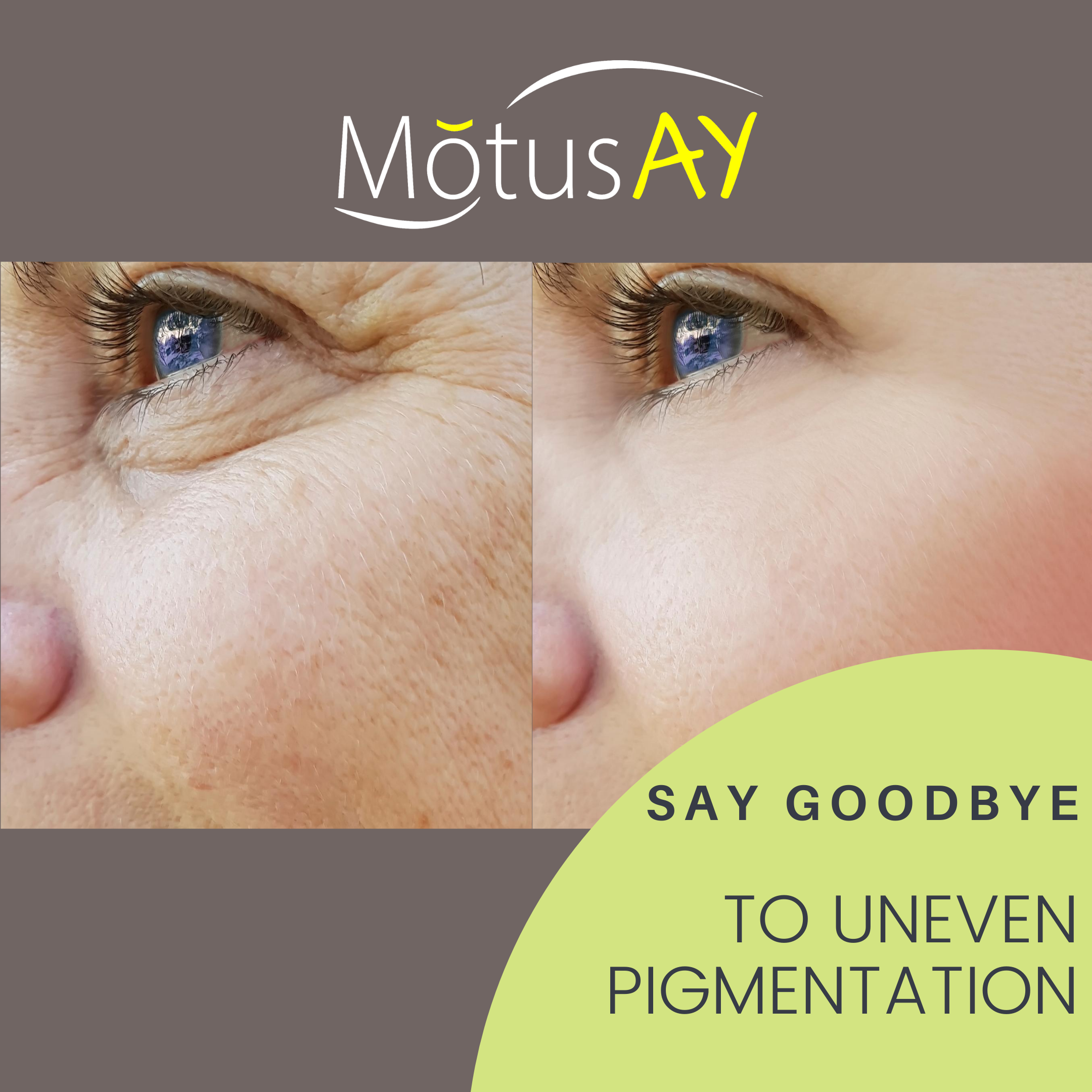 Motus AY Laser Treatment for Brown Spots Removal - Safe & Effective Skin Pigmentation Corrector for Face & Body - Perfect for Age Spots, Sun Spots & Hyperpigmentation at Home or Clinic