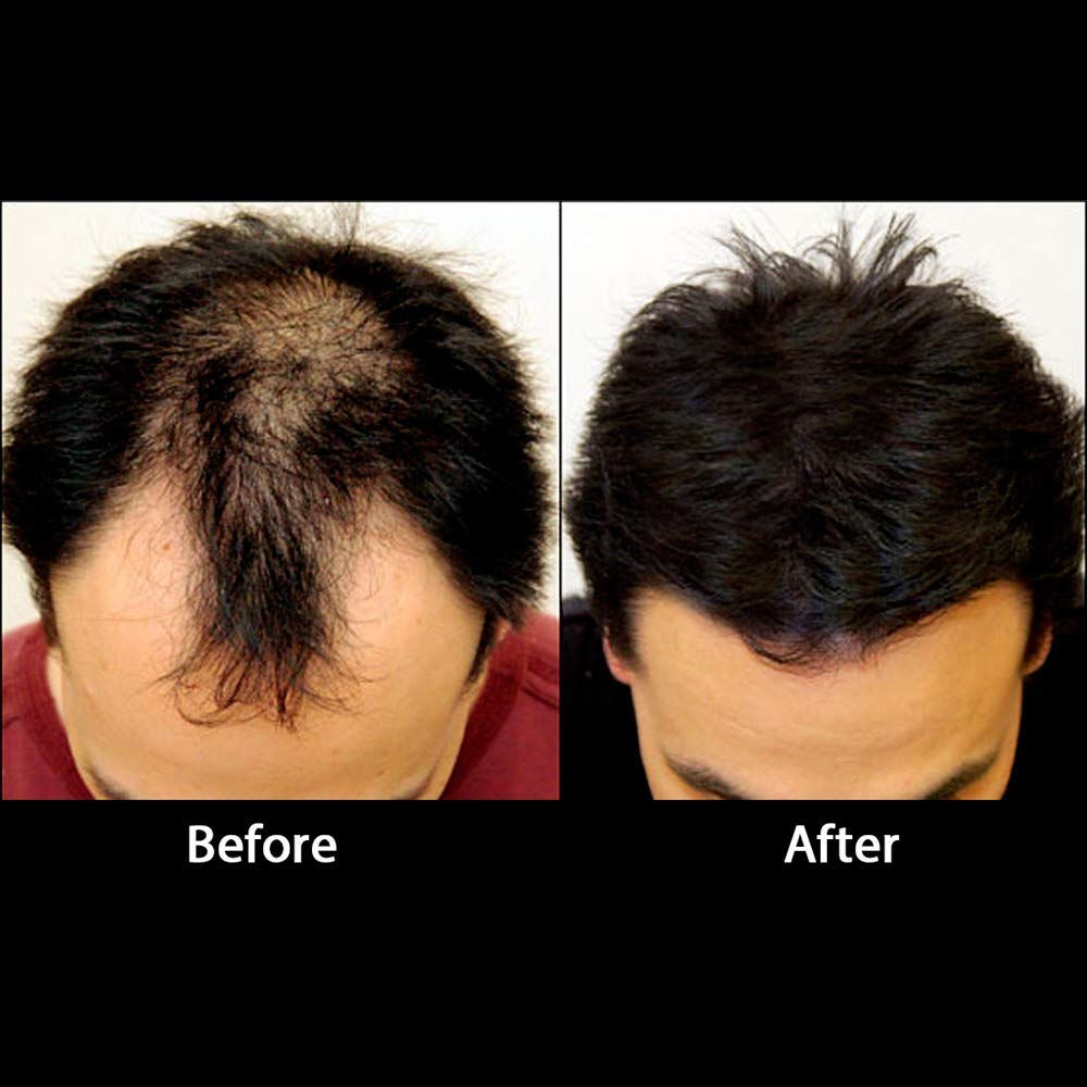 Kabello Refill Pack for All Protein Hair Building Fibers with Hairline Comb - 12g Dark Brown | Natural-Looking Hair Thickening Solution for Men & Women | Perfect for Daily Use, Special Occasions & Confidence Boosting