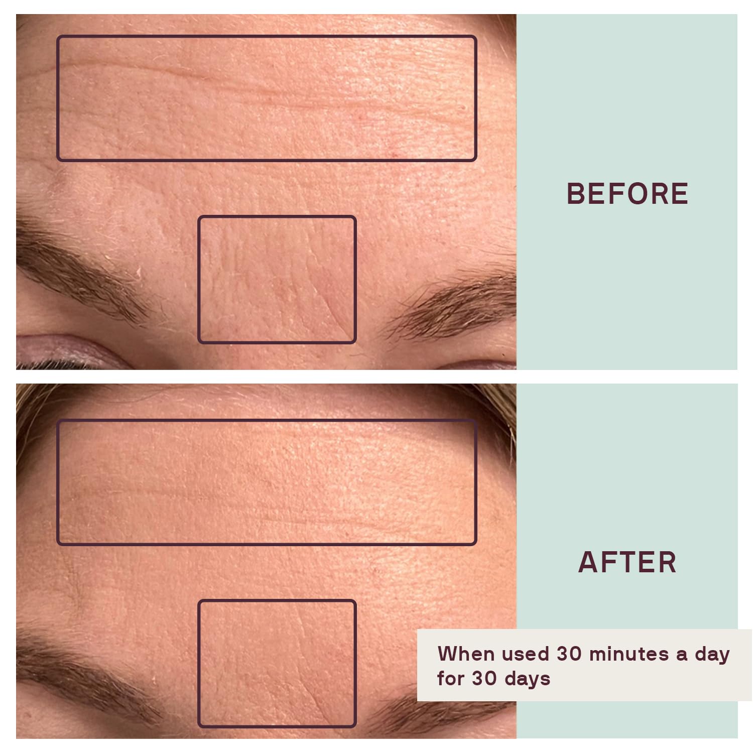 Dermaclara Anti-Wrinkle Silicone Face Patches Kit - Forehead, Smile Lines & Frown Line Treatment with Cleanser (30 Uses) - 1 Forehead, 2 Mouth, 2 Eye, 1 Neck Patches - Perfect for Overnight Wrinkle Reduction & Skin Smoothing