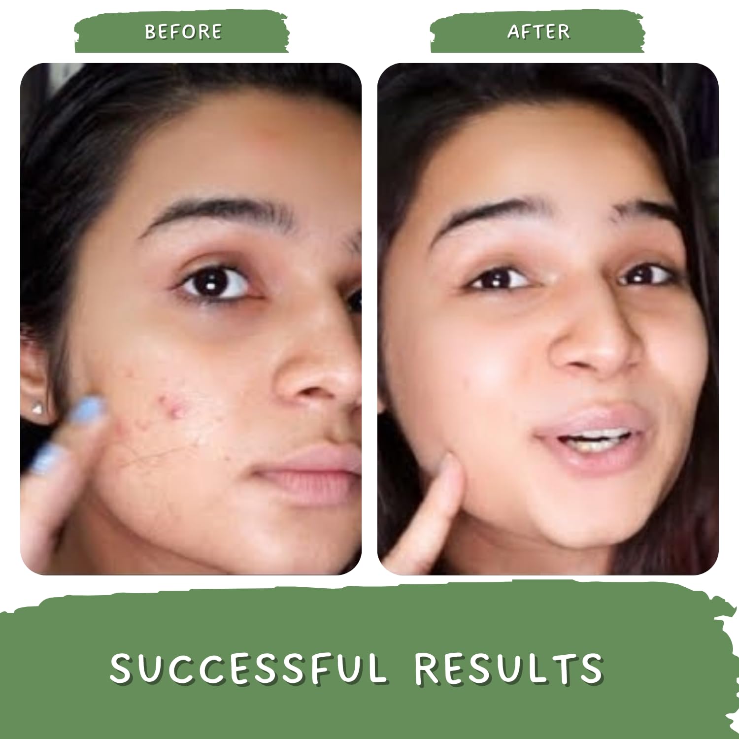 Mystiq Living Green Tea Anti-Acne Face Mask | Clarifying Treatment for Pimples & Acne Marks | Oily, Acne-Prone & Combination Skin Care | 100g | Perfect for Daily Skincare & Post-Breakout Recovery
