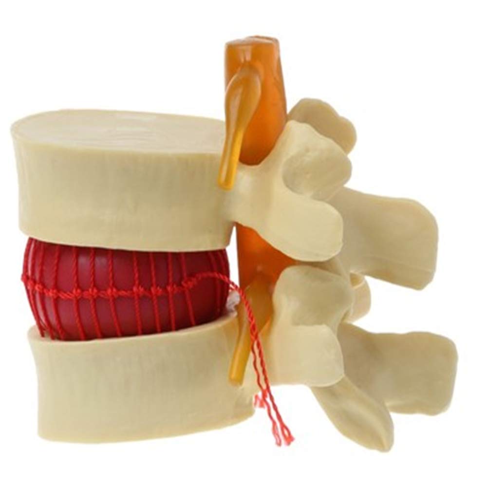 Human Spine Model - Anatomical Lumbar Disc Herniation Medical Teaching Tool for Students & Professionals | Perfect for Classroom Demonstrations, Medical Training & Patient Education