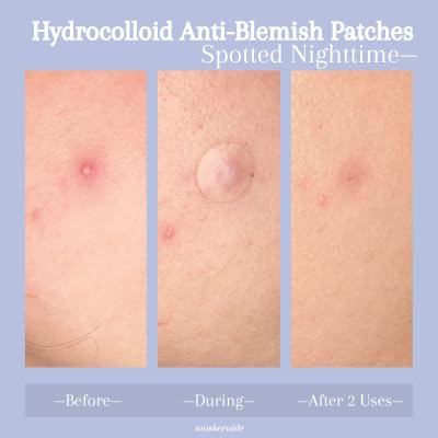 Spotted Nighttime Hydrocolloid Acne Pimple Patches - 54 Count, 2 Sizes (Large & Small) for Blemish Treatment | Vegan & Cruelty-Free | Absorbs Impurities Overnight | Perfect for Teen & Adult Skin Care Routine