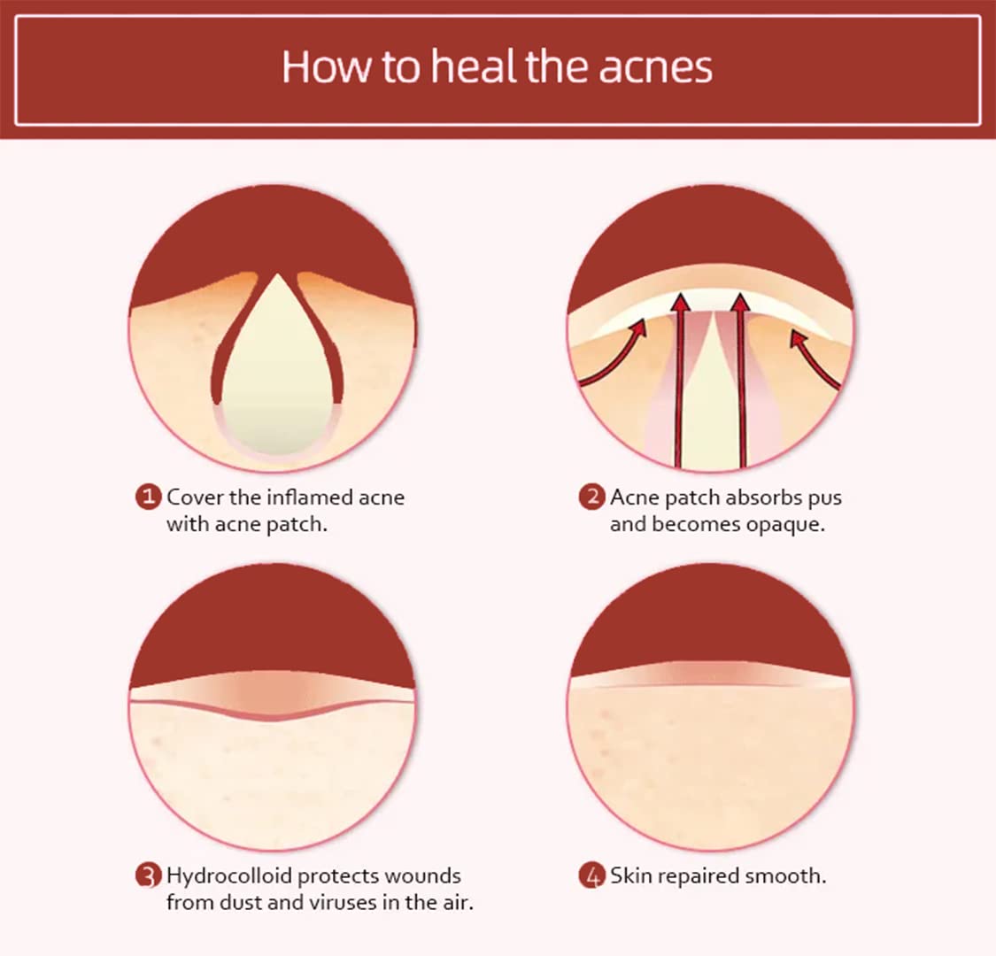 Original Hydrocolloid Acne Patches for Pimples & Blemishes - Vegan-Friendly, Cruelty-Free (36 Count) - Face & Skin Spot Treatment Stickers for Overnight Healing & Daily Use