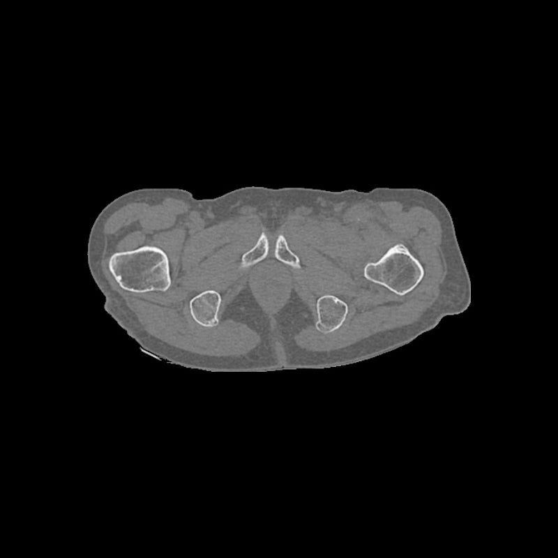 High-Quality Femoral Neck Fracture Pelvis Phantom for CT Scan & X-Ray Training - Perfect for Medical Education & Radiology Practice